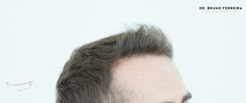 Dr Bruno Ferreira FUE 5 months after