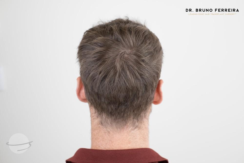 Dr Bruno Ferreira FUE donor area before