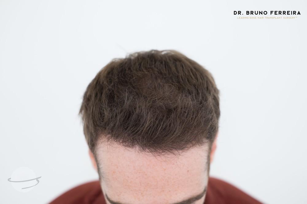 Dr Bruno Ferreira FUE 5 months after