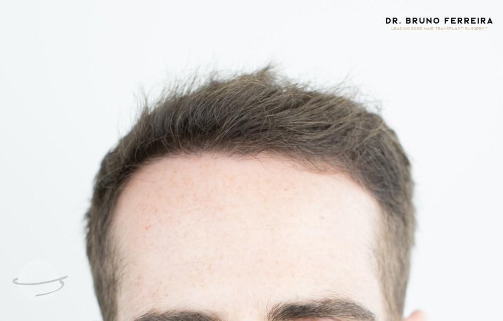 Dr Bruno Ferreira FUE 5 months after