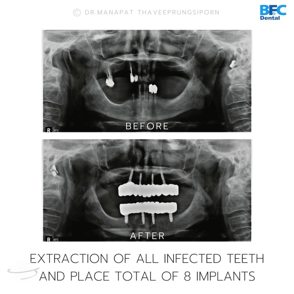 DENTAL ALL ON 4 case-1.2-1