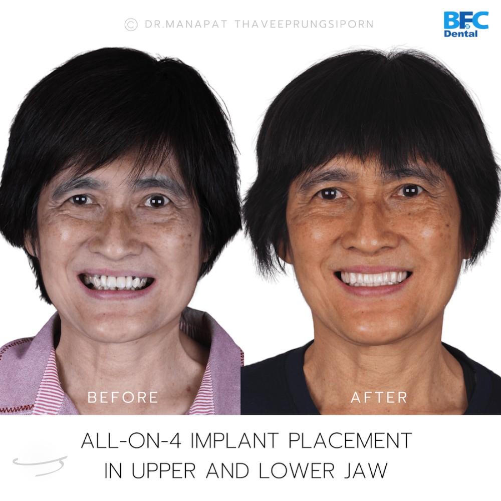 DENTAL ALL ON 4 case-2-1