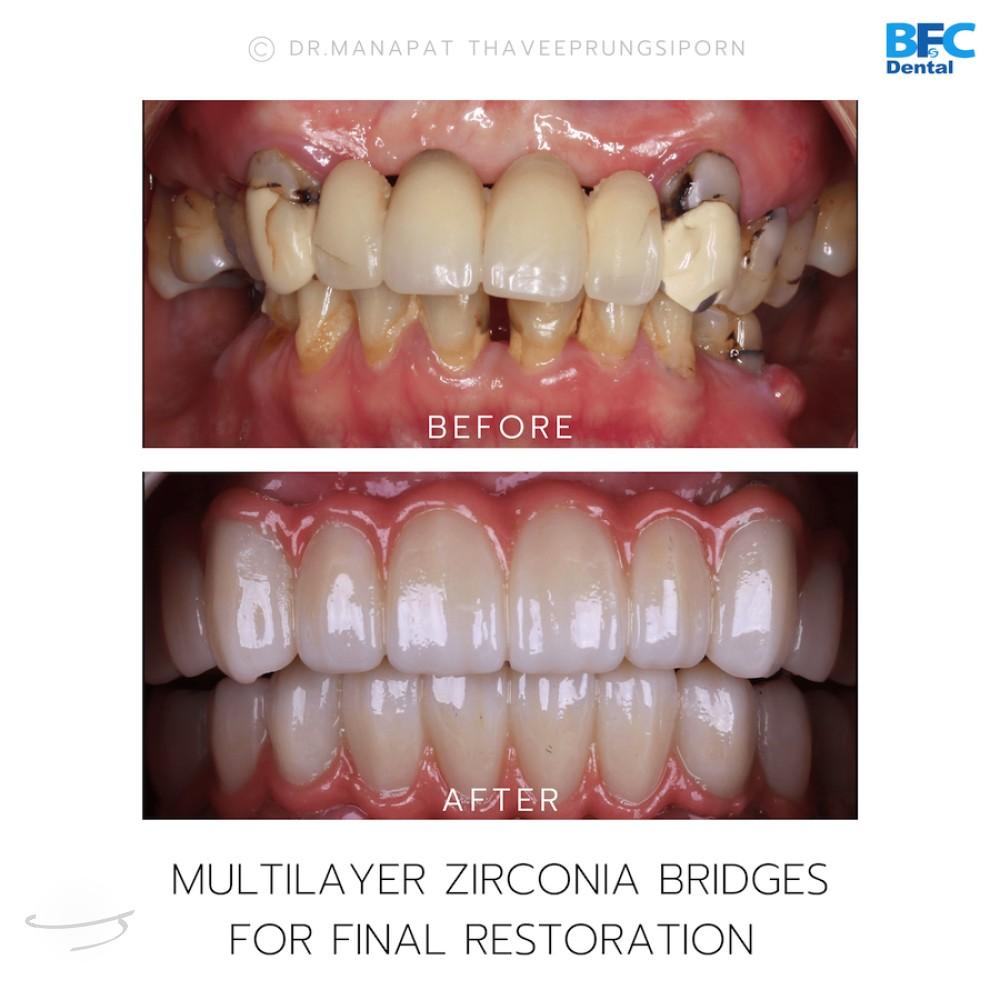 DENTAL ALL ON 4 case-2.1-1