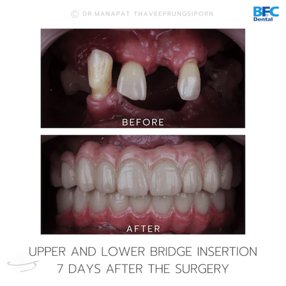 DENTAL ALL ON 4 case-3.1-1