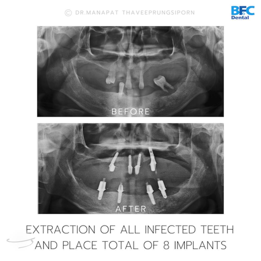 DENTAL ALL ON 4 case-3.2-1