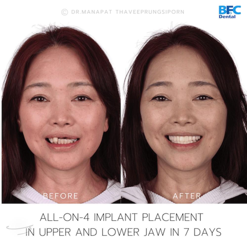 DENTAL ALL ON 4 case-6-1