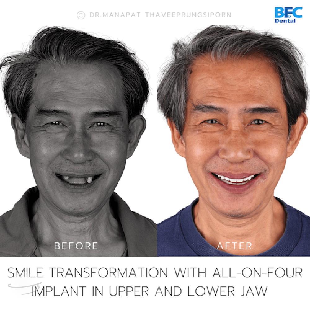 DENTAL ALL ON 4 case-7-1