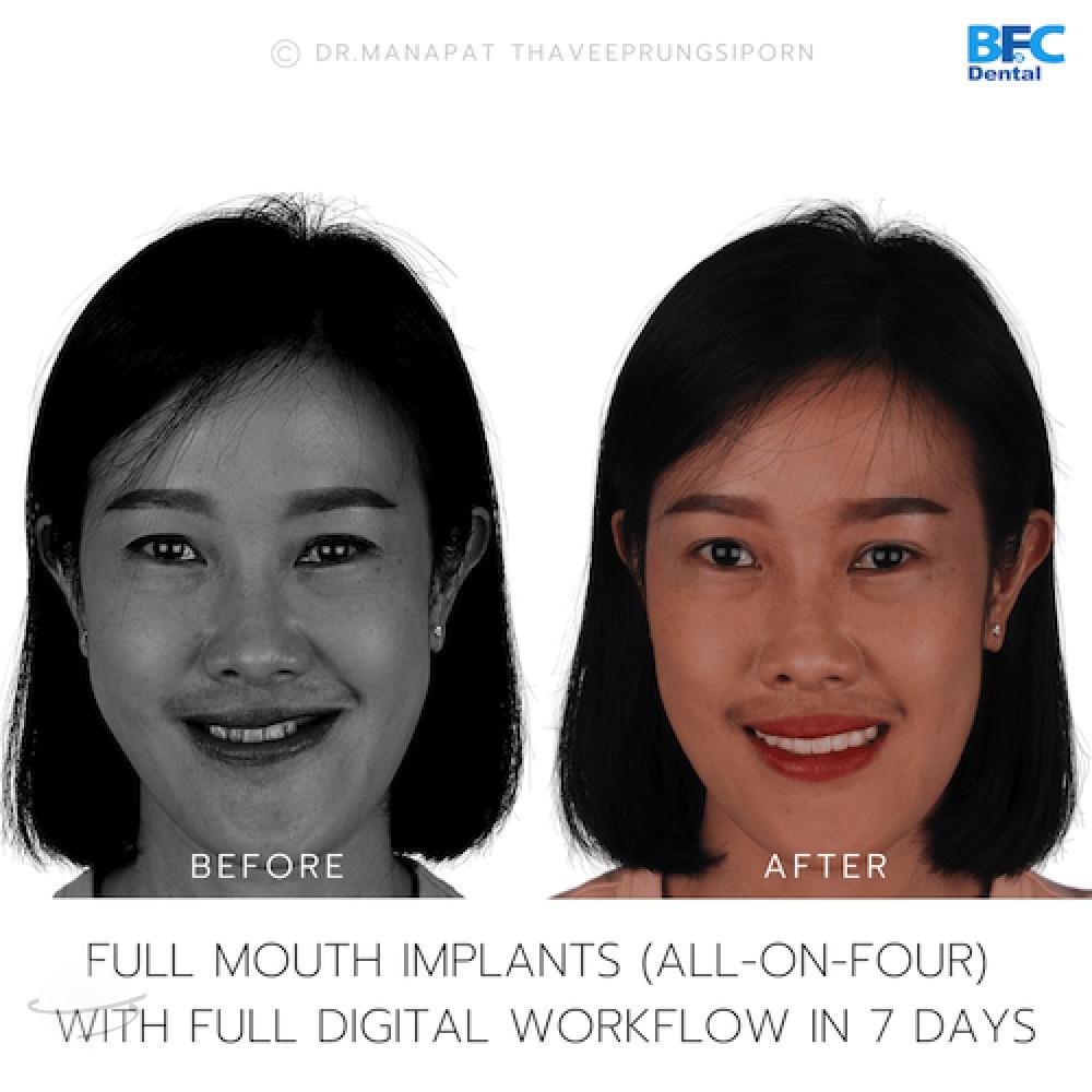 DENTAL ALL ON 4 case-8-1