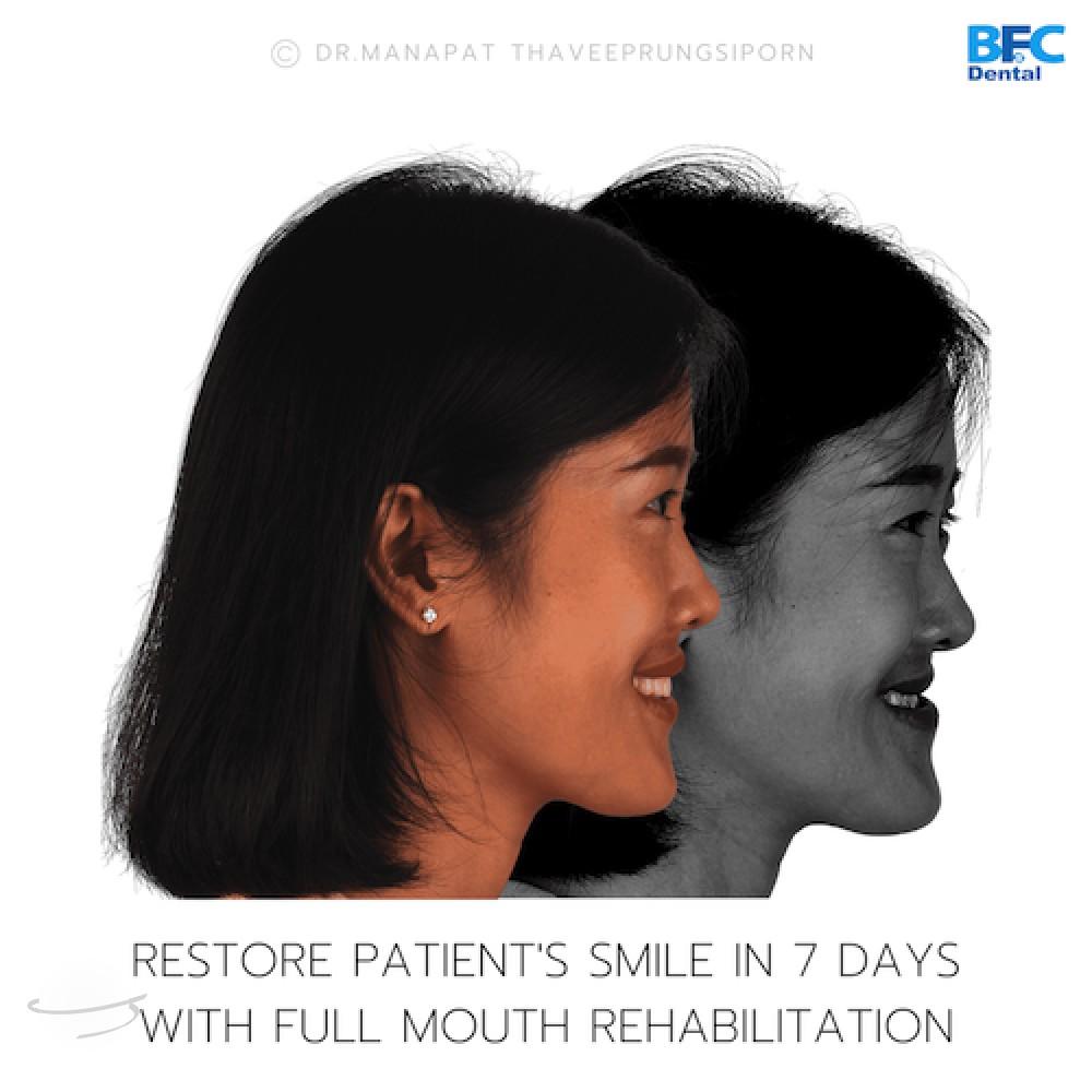 DENTAL ALL ON 4 case-8.2-1