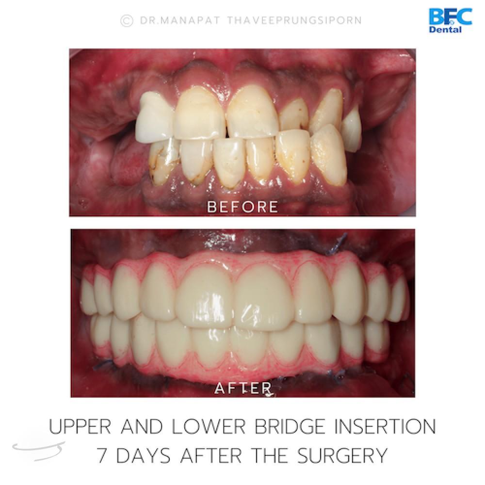 DENTAL ALL ON 4 case-12.1