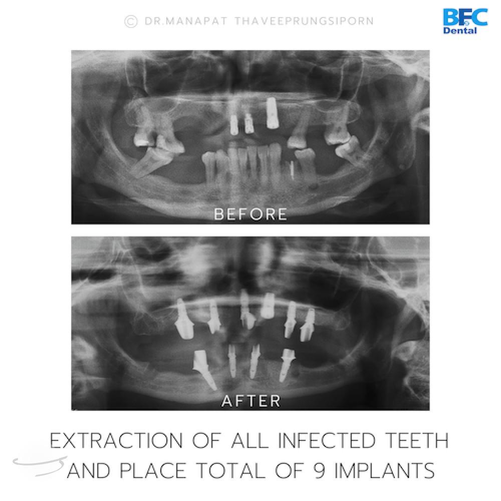DENTAL ALL ON 4 case-13.2
