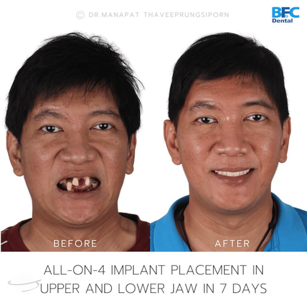 DENTAL ALL ON 4 case-3-1