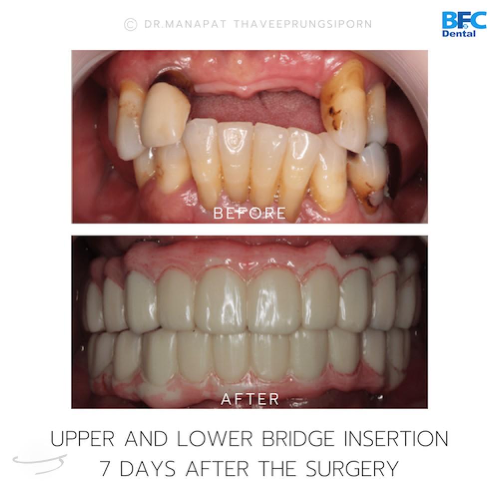 DENTAL ALL ON 4 case-6.1-1