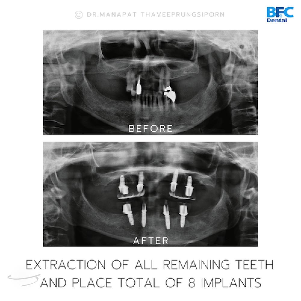 DENTAL ALL ON 4 case-6.2-1