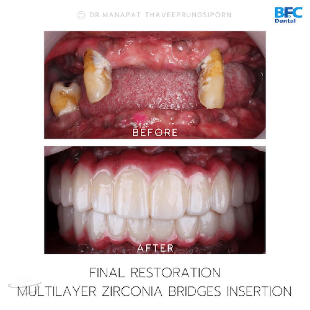 DENTAL ALL ON 4 case-7.1-1