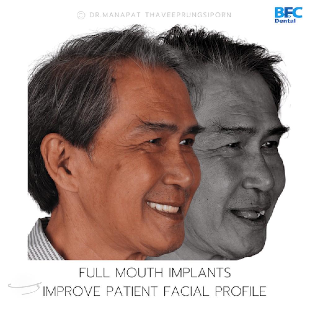 DENTAL ALL ON 4 case-7.2-1