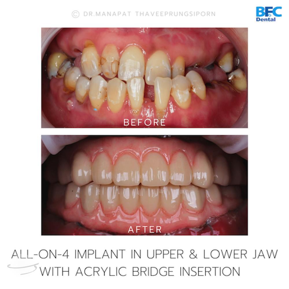 DENTAL ALL ON 4 case-8.1-1