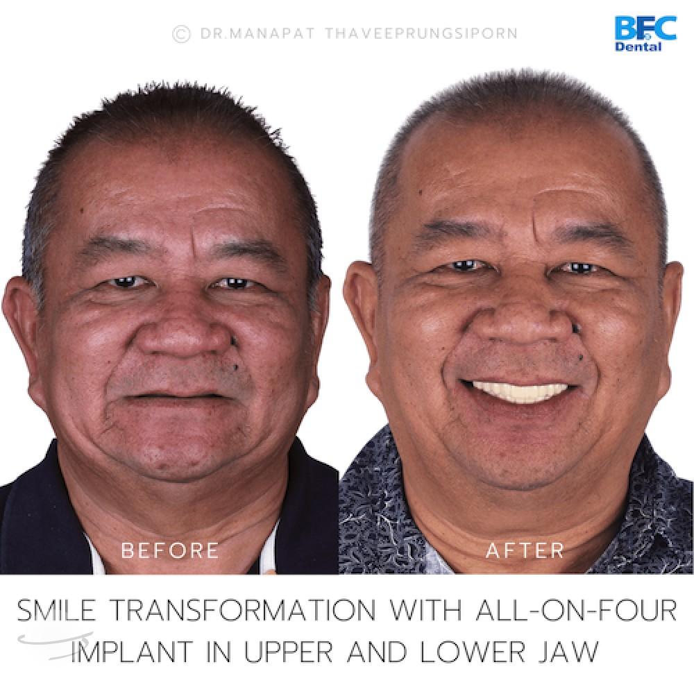 DENTAL ALL ON 4 case-9-1