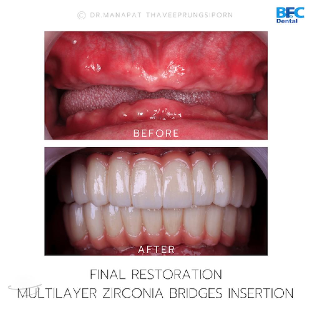 DENTAL ALL ON 4 case-9.1-1