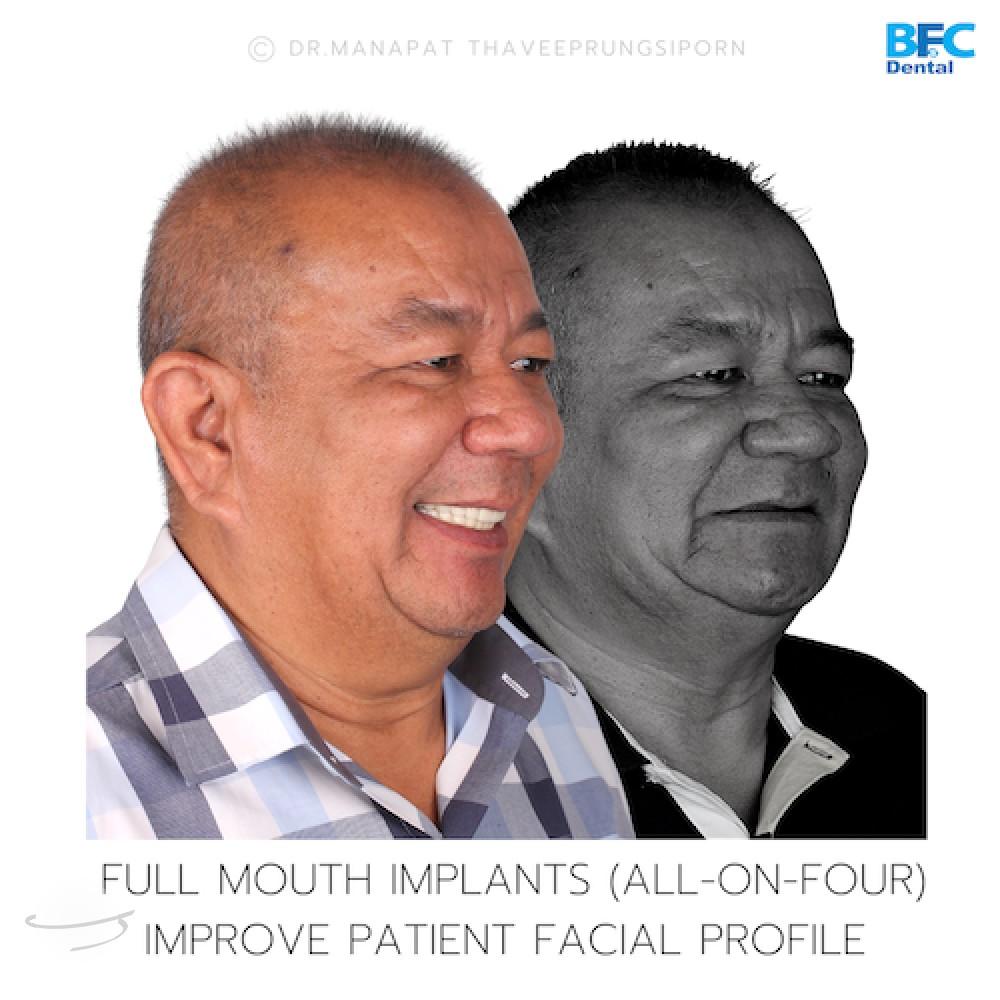 DENTAL ALL ON 4 case-9.2-1