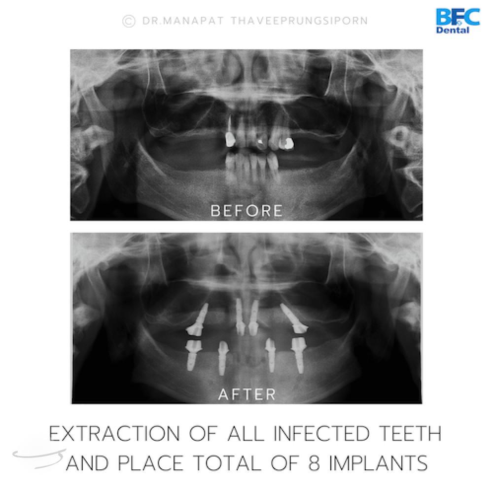 DENTAL ALL ON 4 case-12.2