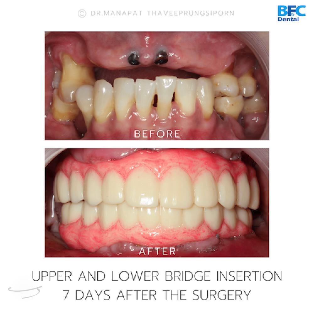 DENTAL ALL ON 4 case-13.1