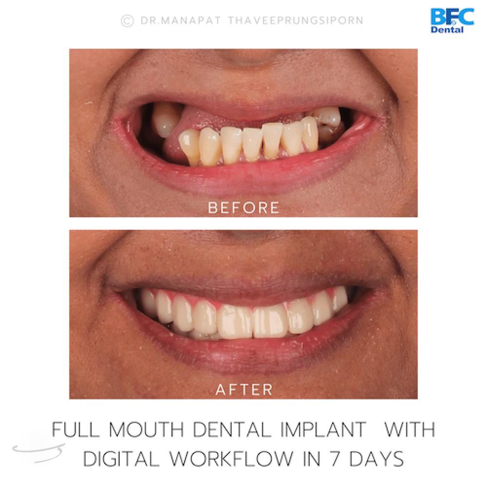 DENTAL ALL ON 4 case-13