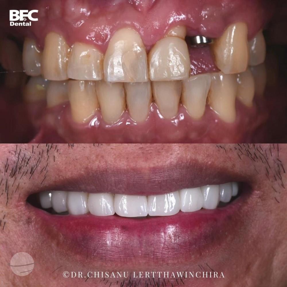 ceramic-veneers-crown-5