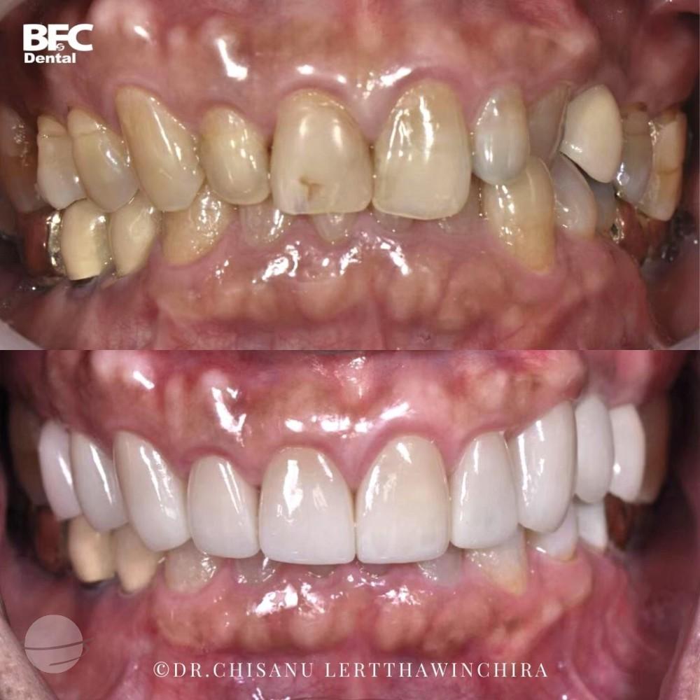 ceramic-veneers-9-clear-aligner