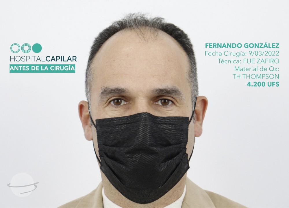 hospital capillar before hair transplant