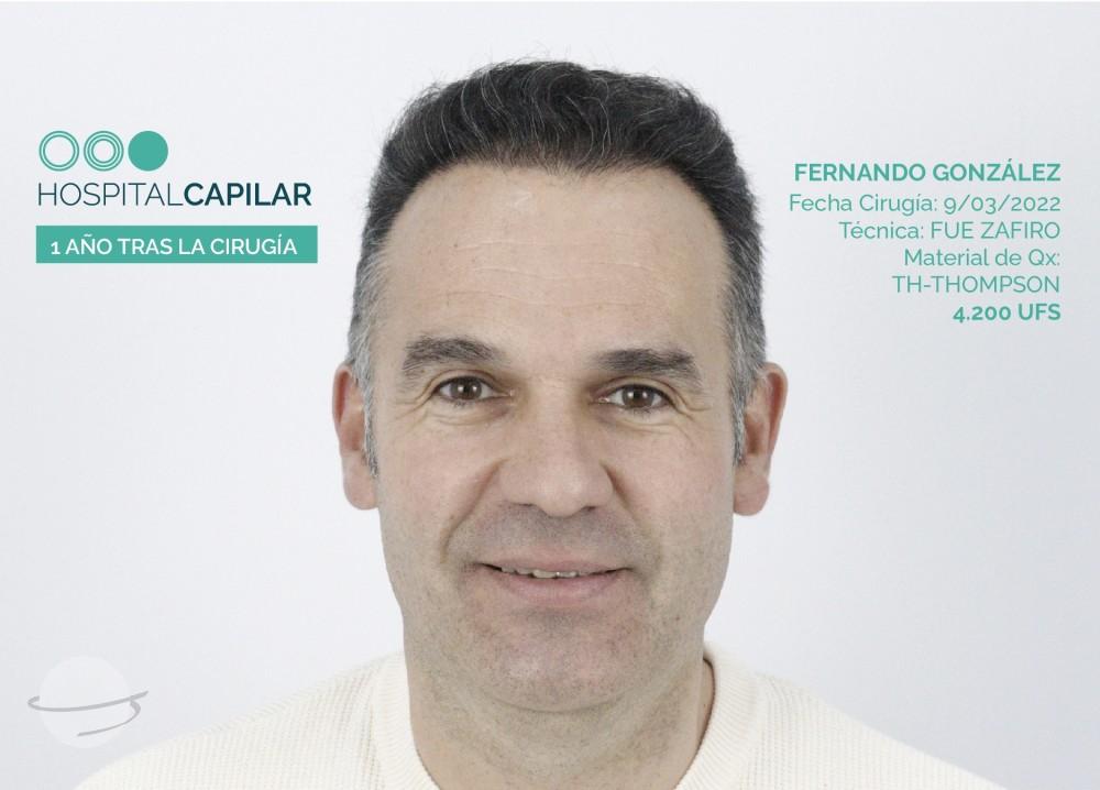 hospital capillar results hair transplant