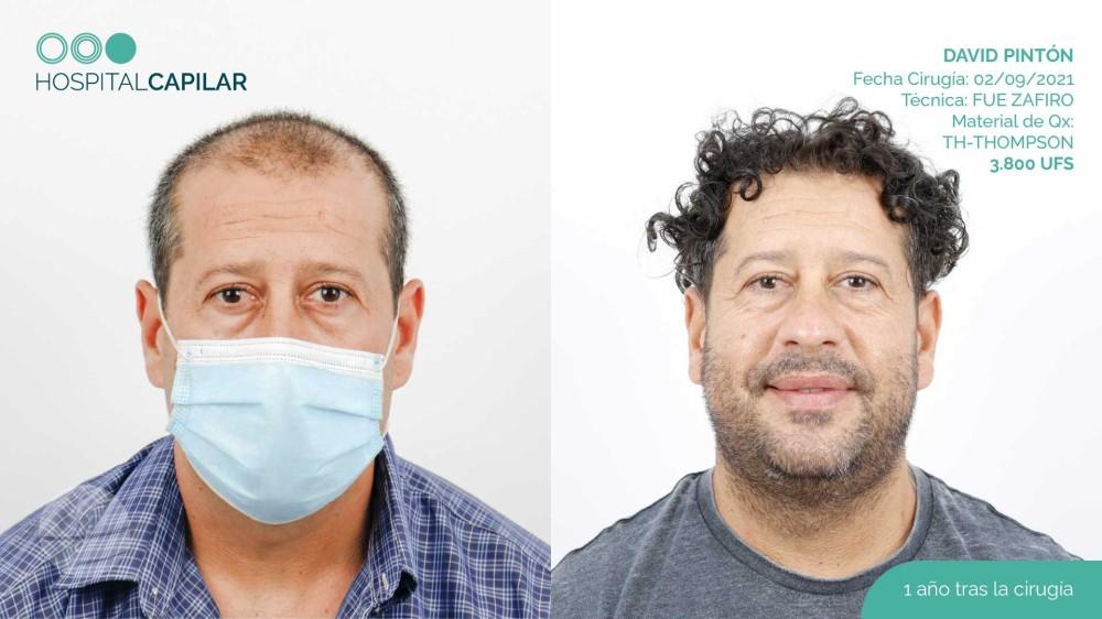 hospital capillar before and after hair transplant