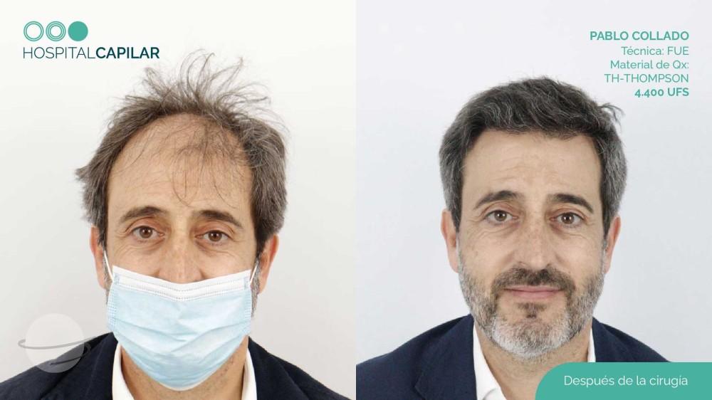 hospital capillar before and after hair transplant