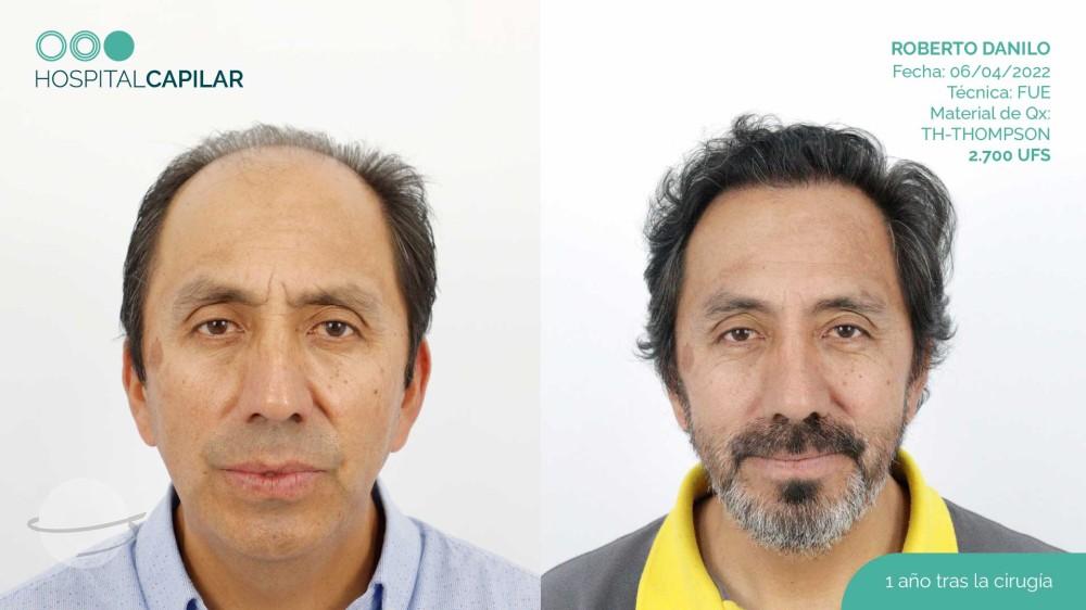 hospital capillar before and after hair transplant