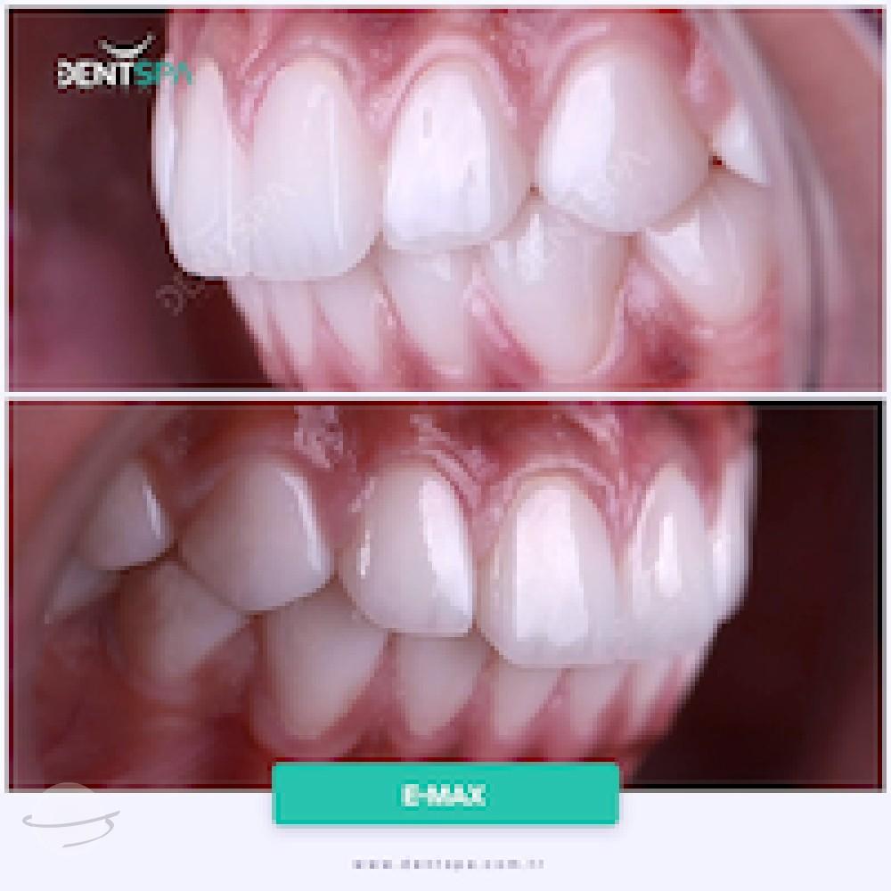 DENTSPA ISTANBUL EMAX VENEERS4