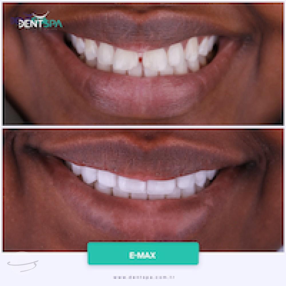 DENTSPA ISTANBUL EMAX VENEERS10