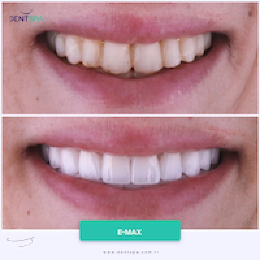 DENTSPA ISTANBUL EMAX VENEERS9