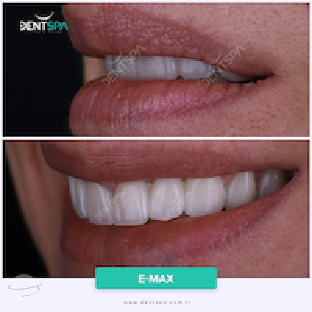 DENTSPA ISTANBUL EMAX VENEERS3