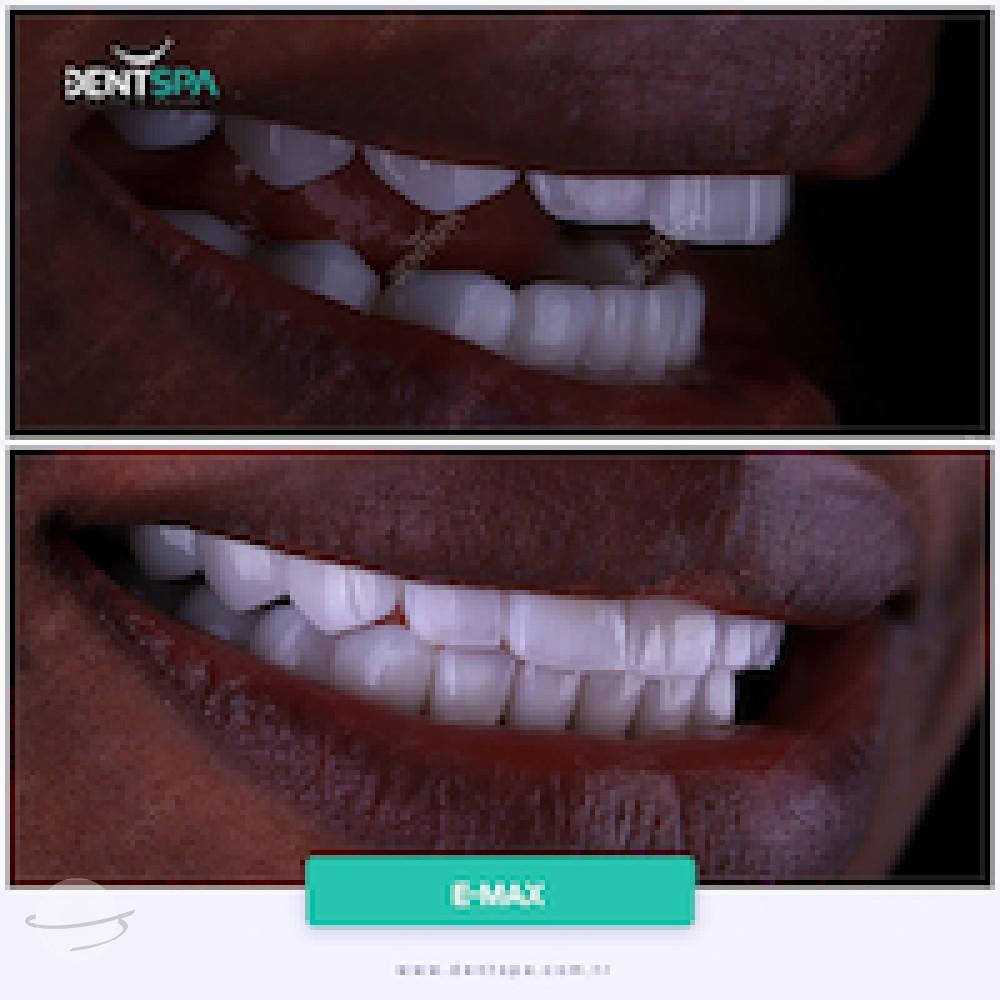 DENTSPA ISTANBUL EMAX VENEERS8
