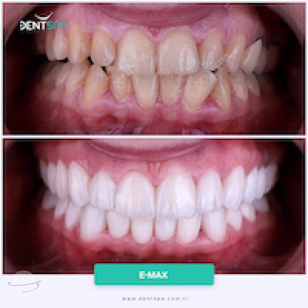 DENTSPA ISTANBUL EMAX VENEERS6