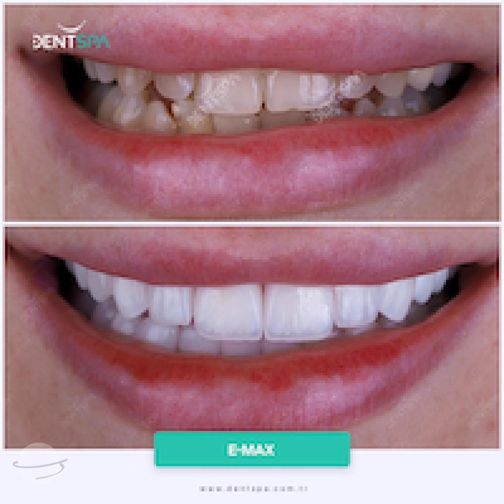 DENTSPA ISTANBUL EMAX VENEERS7