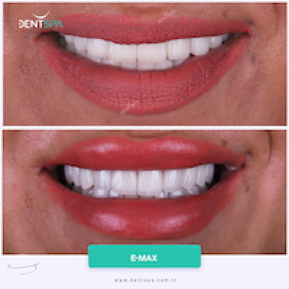 DENTSPA ISTANBUL EMAX VENEERS11