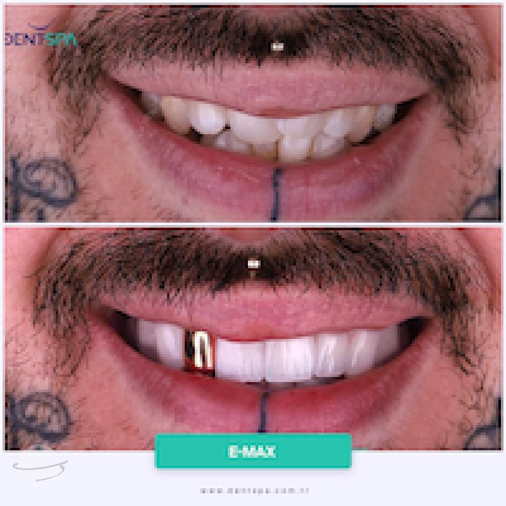 DENTSPA ISTANBUL EMAX VENEERS12