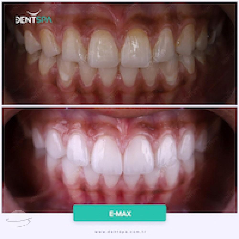 DENTSPA ISTANBUL EMAX VENEERS15