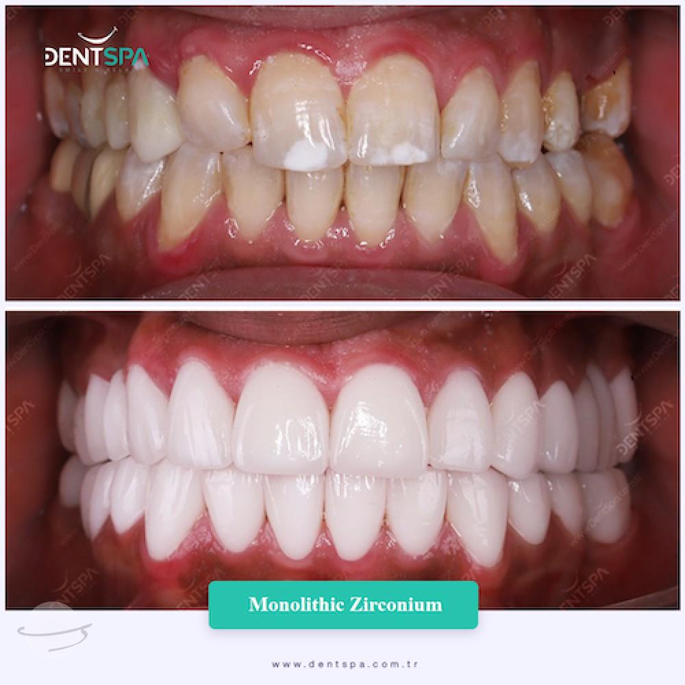 DENTSPA ISTANBUL ZIRCONIUM CROWNS 2