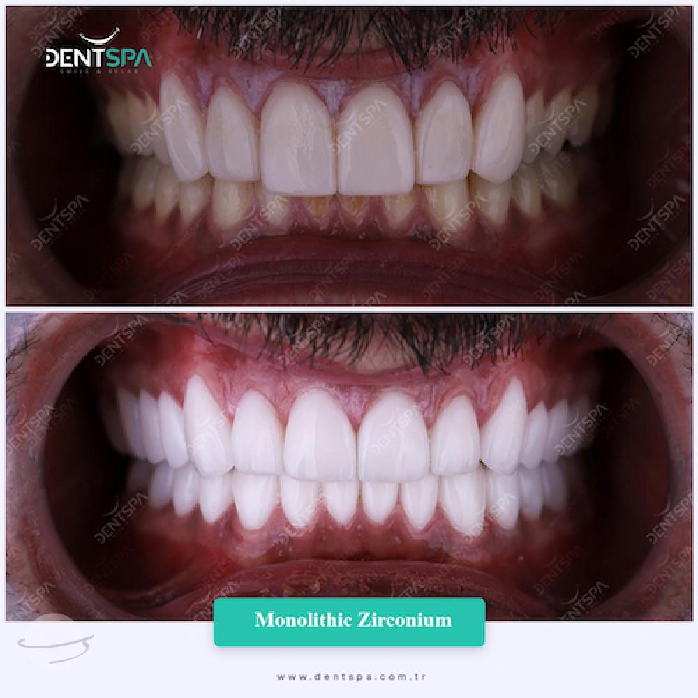 DENTSPA ISTANBUL ZIRCONIUM CROWNS 1