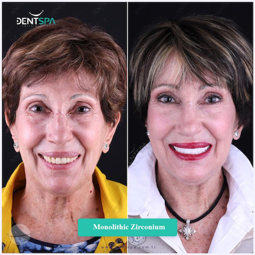 DENTSPA ISTANBUL ZIRCONIUM CROWNS 7