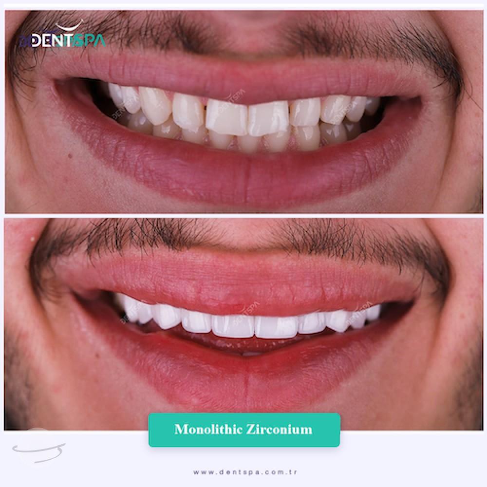 DENTSPA ISTANBUL ZIRCONIUM CROWNS 8