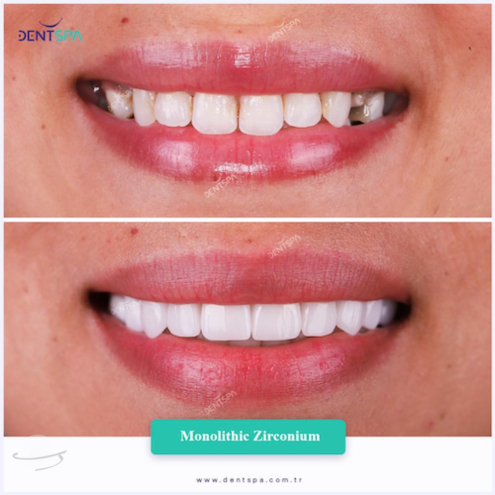 DENTSPA ISTANBUL ZIRCONIUM CROWNS 10