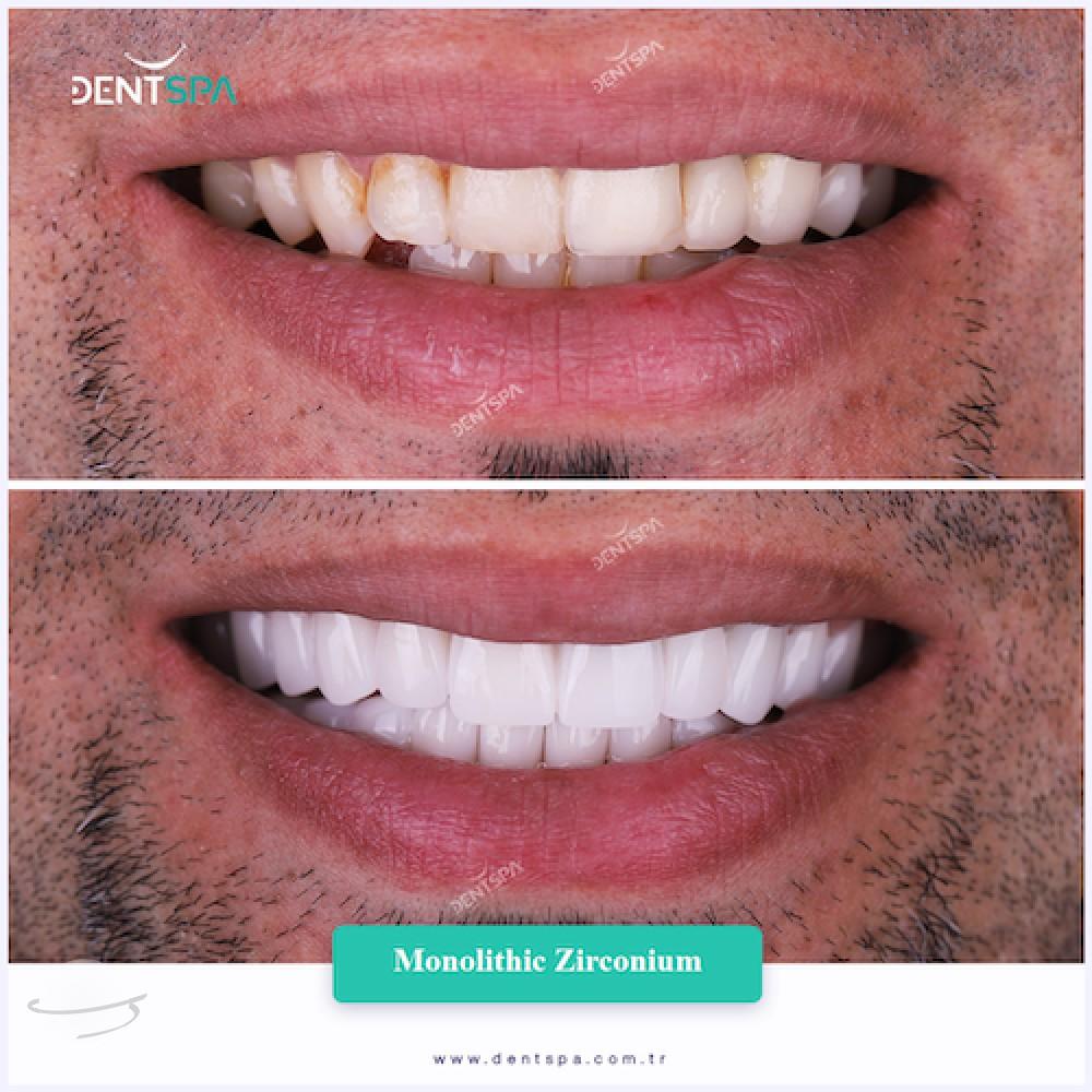 DENTSPA ISTANBUL ZIRCONIUM CROWNS 11